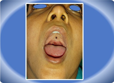 PALATAL FISTULA